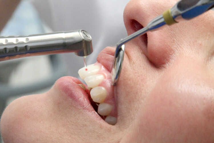 Laserbehandlung - Zahnarztpraxis Langenfeld